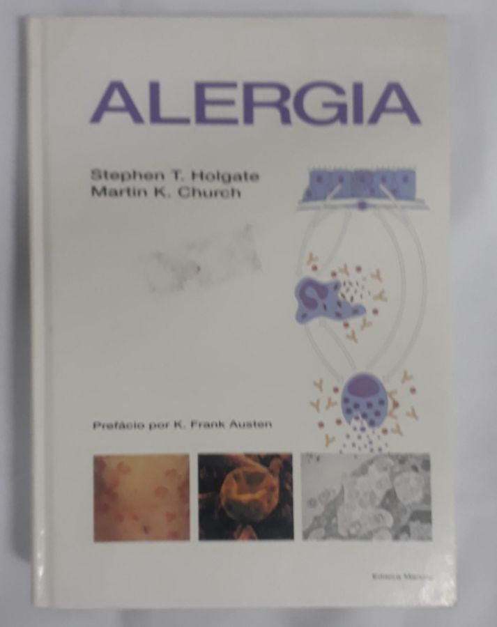 <a href="https://www.touchelivros.com.br/livro/alergia/">Alergia - Stephen T. Holgate</a>